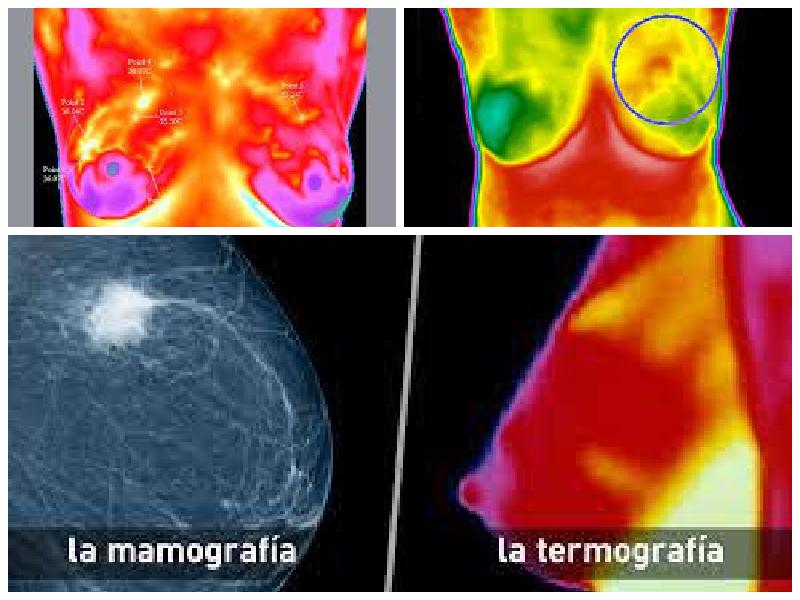 termografia-mamografia